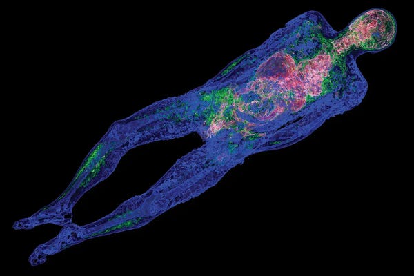 Human Body, Pet-CT Scan