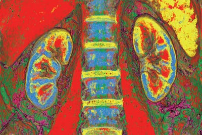 Canvas Print: Kidneys, CT Scan by Science Photo Library - thumbnail